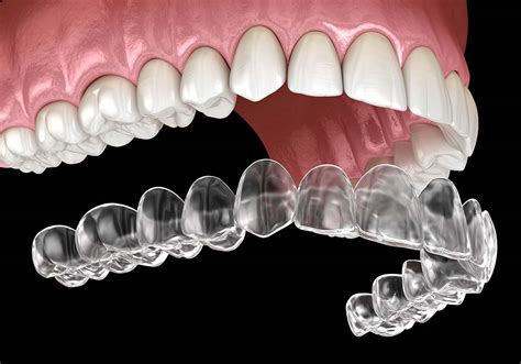 The Role of Retainers in Smile Magic Staples Treatment